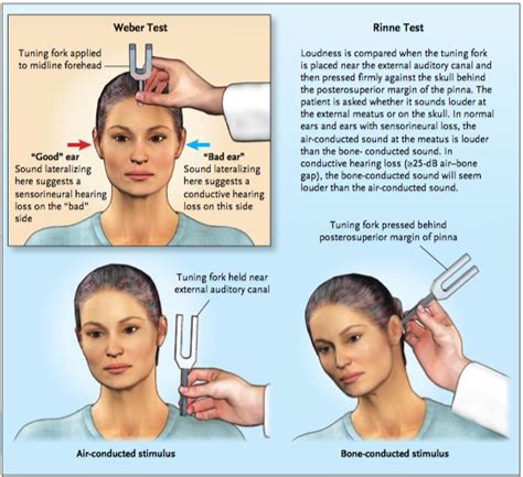 how to perform rinne test